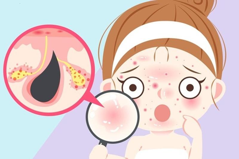 Mụn tuổi dậy thì