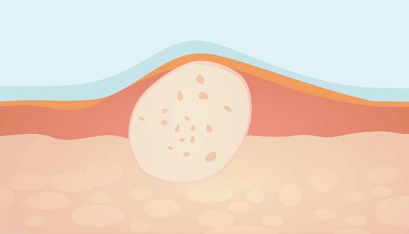 Mụn ẩn dưới da