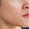 Da dầu mụn mãi không hết? Nhiều người mắc cùng một sai lầm khiến mụn tái phát
