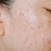 Sữa rửa mặt nên có trong routine da dầu mụn của Trioderma?
