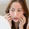 Vì sao cùng một chu trình nhưng da vẫn breakout khi hè đến? Giải đáp với Trioderma