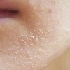 Giải mã lotion dưỡng ẩm, kiềm dầu cho da mụn nhạy cảm đang được chú ý