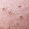 Mụn Đầu Đen: Cách Loại Bỏ Tận Gốc Với Trioderma - Chấm Dứt 