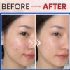 Review chấm mụn viêm mới Trioderma Intensive Acne Spot Gel: ‘Cứu tinh’ cho làn da