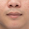 Gel chấm mụn nên dùng khi nào? Những lưu ý trước khi chấm mụn