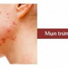 Mụn Trứng Cá Là Gì? Giải Pháp Hiệu Quả Với Gel Chấm Mụn Trioderma